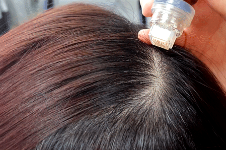 EHPlus Scalp Spa ION-TO DS Ampoule + MTS (1ea)